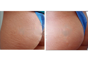 Antes y después eliminación de estrías