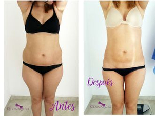 antes y después lipoláser