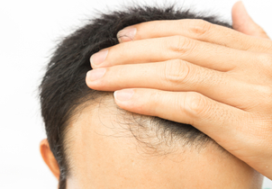 Causas de la alopecia