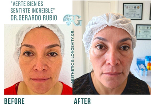 Resultados peeling