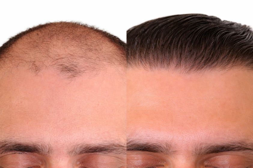 Trasplante de cabello
