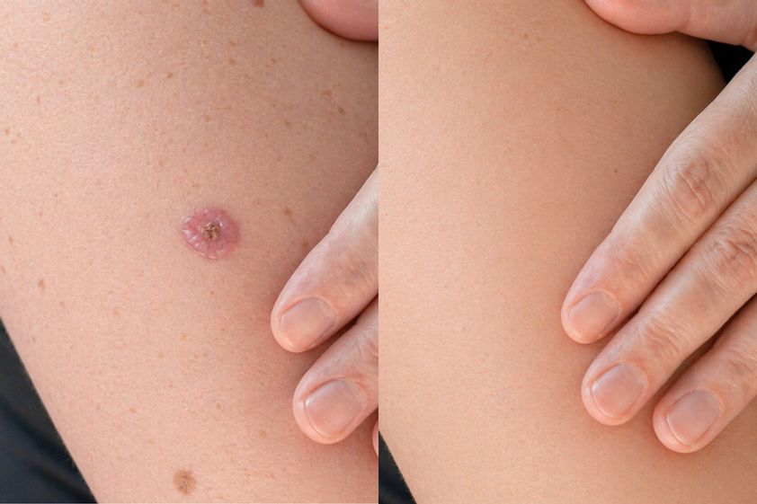 Carcinoma Basocelular