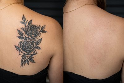 Antes y después de Eliminación de tatuajes