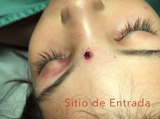 Así se quita una bala en la cara
