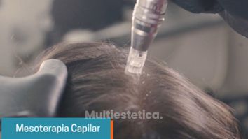 Mesoterapia capilar