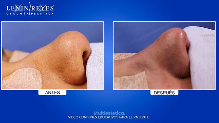 Rinoplastia