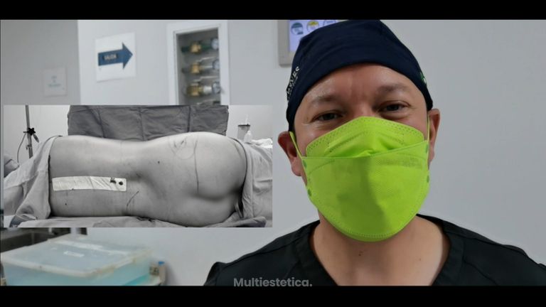 Liposucción - Dr. Lenin Alfonso Reyes Ibarra