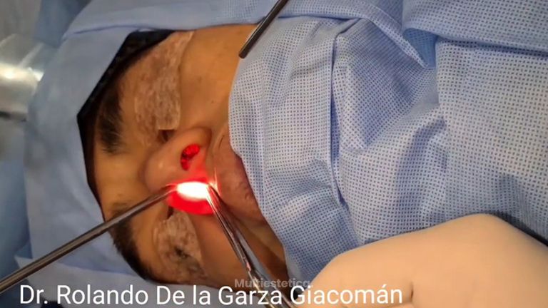 Rinoplastia - Fasent. Dr Rolando de la Garza Giacomán