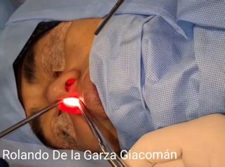 Rinoplastia - Fasent. Dr Rolando de la Garza Giacomán