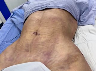 Lipoescultura - Dr. Rigoberto Castellanos