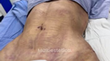 Lipoescultura - Dr. Rigoberto Castellanos