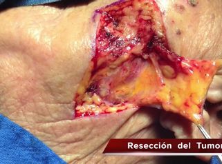 Cirugía para eliminar cáncer de piel