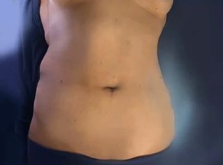 Que es la Abdominoplastia? - Dra. Rosy Mercado