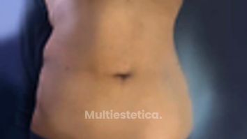 Que es la Abdominoplastia? - Dra. Rosy Mercado