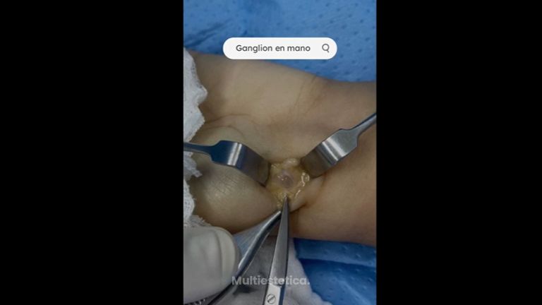 Ganglio en la mano - Dr. Yusef Jiménez Murat