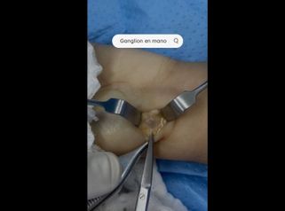 Ganglio en la mano - Dr. Yusef Jiménez Murat