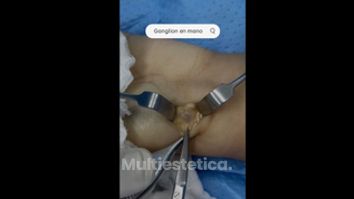 Ganglio en la mano - Dr. Yusef Jiménez Murat