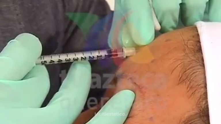 Los beneficios dLa toxina botulínica para el rejuvenecimiento facial