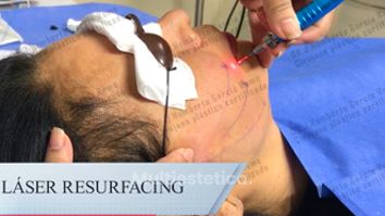 Láser Resurfacing - Dr. Jorge Humberto García Romo