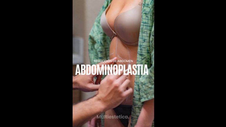 Abdominoplastia - Dr. Gerardo Rayón Nieva