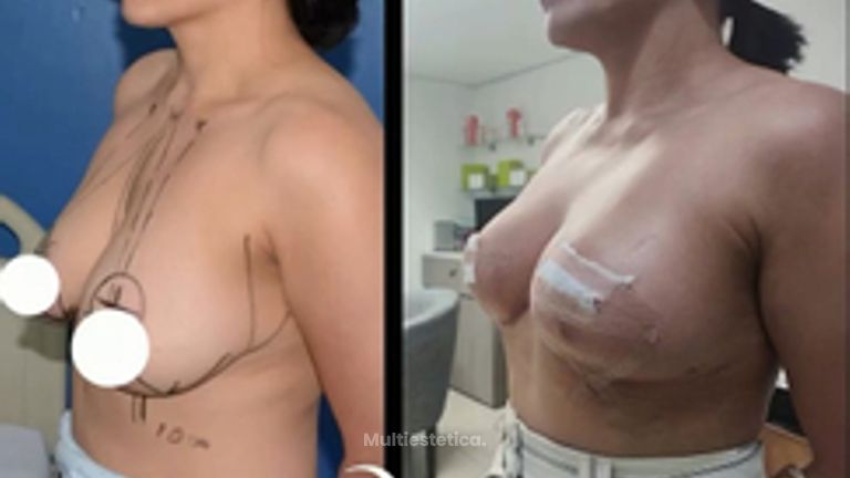 Mastopexia - Dr. Alejandro Cruz Segura