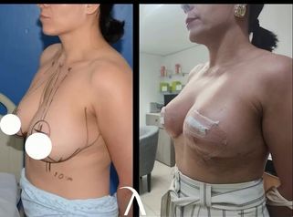 Mastopexia - Dr. Alejandro Cruz Segura