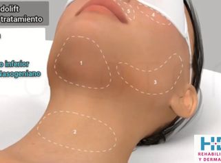 Endolift - Clínica Heal Aesthetics