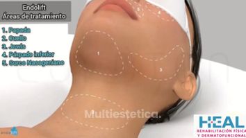 Endolift - Clínica Heal Aesthetics