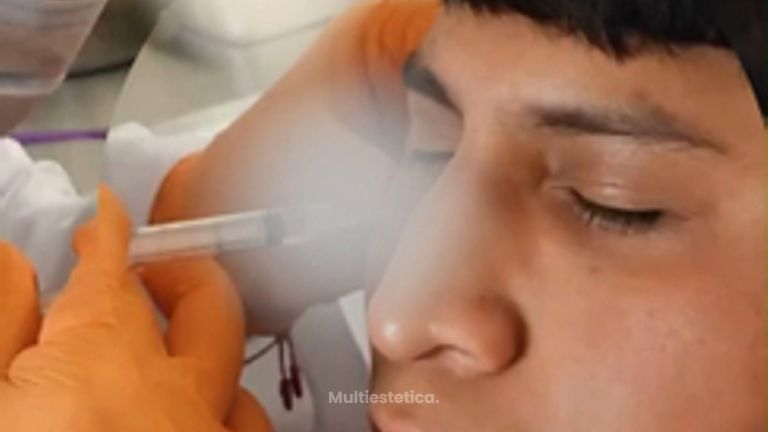Relleno de ojeras - Dr. Andrés Raúl Cortés Ponce