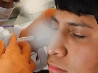 Relleno de ojeras - Dr. Andrés Raúl Cortés Ponce