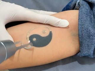 Eliminación de tatuajes - Dr. Raymundo Alfredo Sánchez Martínez