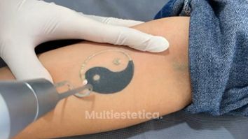 Eliminación de tatuajes - Dr. Raymundo Alfredo Sánchez Martínez