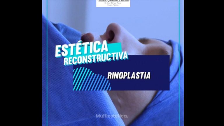 Rinoplastia