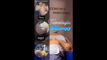 Ultherapy - Joyas Clinique Spa