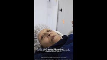 Blefaroplastia - Dr. Lenin Alfonso Reyes Ibarra