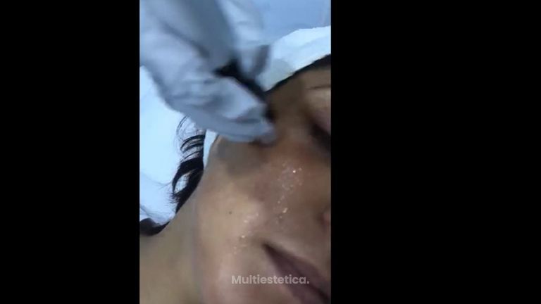 Dermapen con Vitaminas