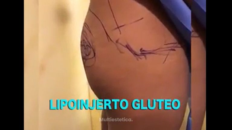Gluteoplastia