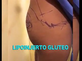 Gluteoplastia