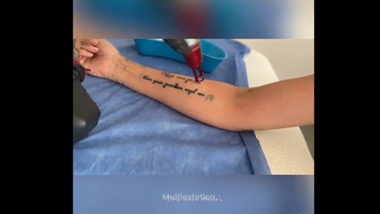 Eliminación Tatuajes - Dra. Ionica Mihaela Dogaru