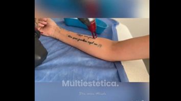 Eliminación Tatuajes - Dra. Ionica Mihaela Dogaru