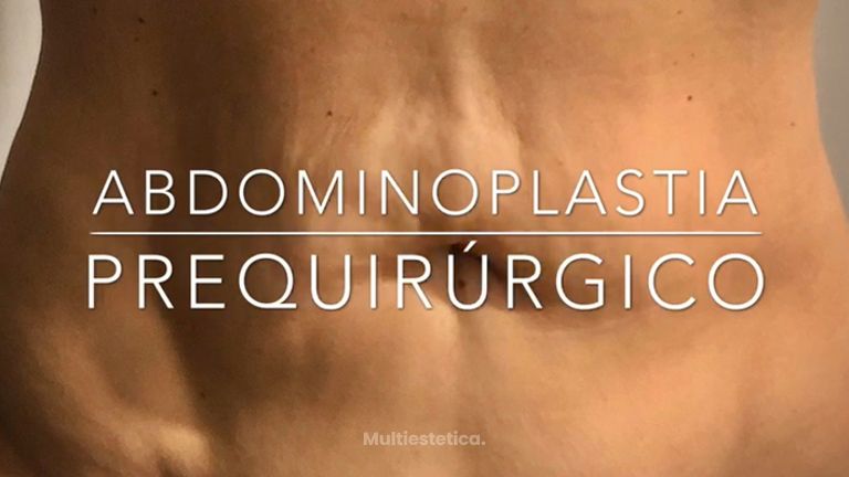 Abdominoplastia 