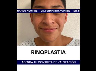 Rinoplastia - Dr. Carlos Fernando Aguirre Muñoz