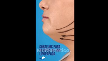 Cirugía de papada - Dr. Mario Alonso Flores Saldivar