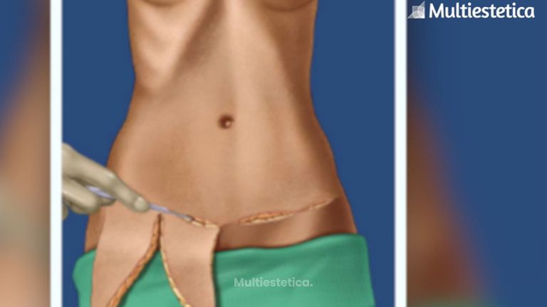 Cirugía plástica referente a Abdominoplastia