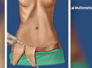 Cirugía plástica referente a Abdominoplastia