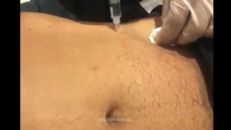 Lipólisis