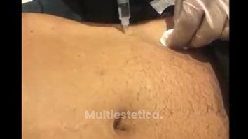 Lipólisis