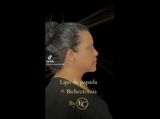 Bichectomía y Lipopapada - Joyas Clinique Spa