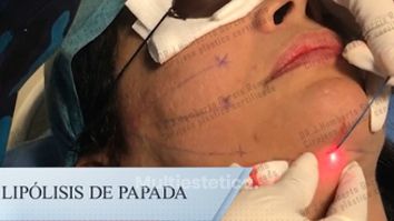 Lipólisis en papada - Dr. Jorge Humberto García Romo