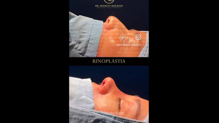 Rinoplastia - Dr. Franco Cravioto